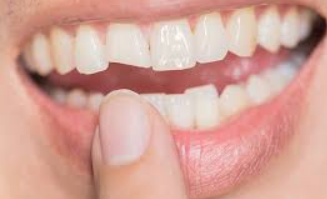 TAMBALAN GIGI ESTETIK